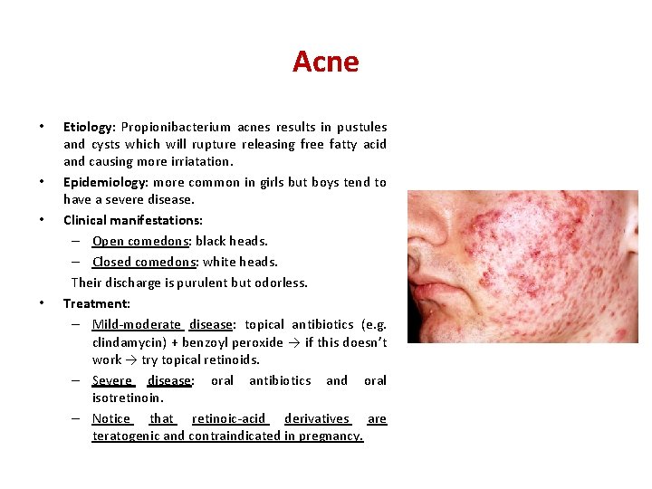 Acne • • Etiology: Propionibacterium acnes results in pustules and cysts which will rupture