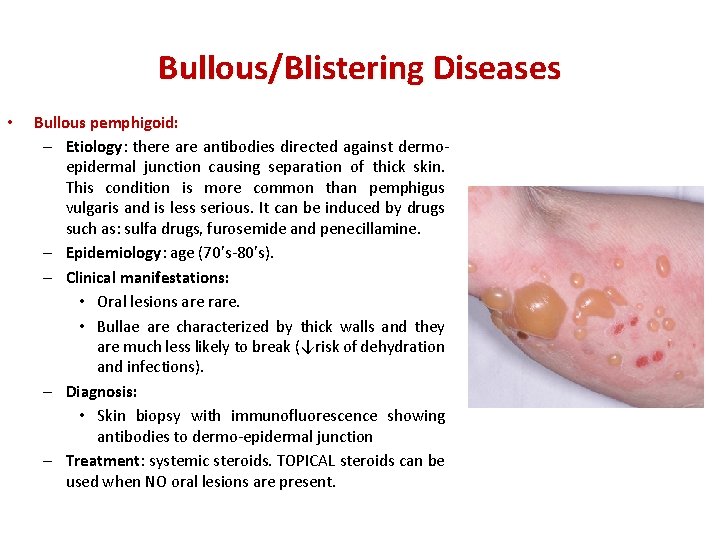Bullous/Blistering Diseases • Bullous pemphigoid: – Etiology: there antibodies directed against dermoepidermal junction causing