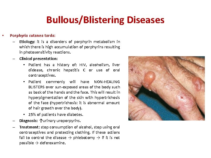 Bullous/Blistering Diseases • Porphyria cutanea tarda: – Etiology: it is a disorders of porphyrin