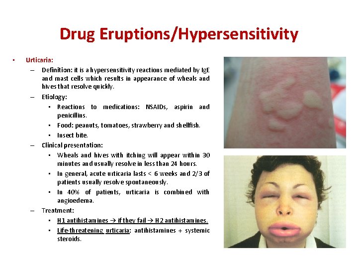 Drug Eruptions/Hypersensitivity • Urticaria: – Definition: it is a hypersensitivity reactions mediated by Ig.