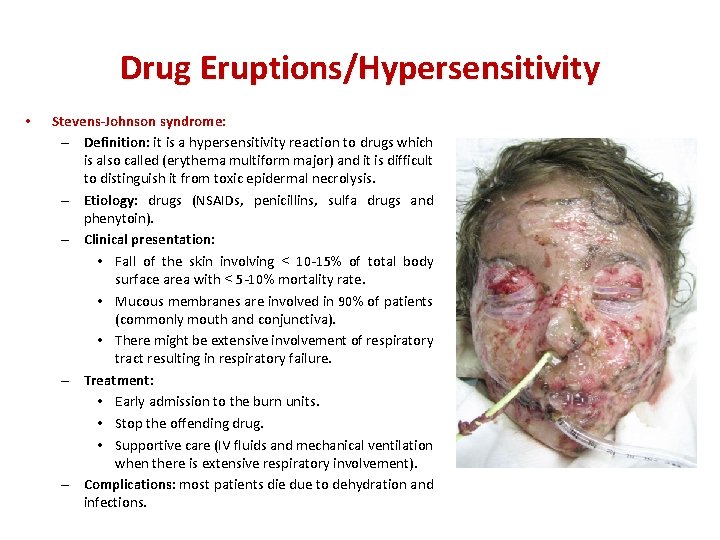 Drug Eruptions/Hypersensitivity • Stevens-Johnson syndrome: – Definition: it is a hypersensitivity reaction to drugs