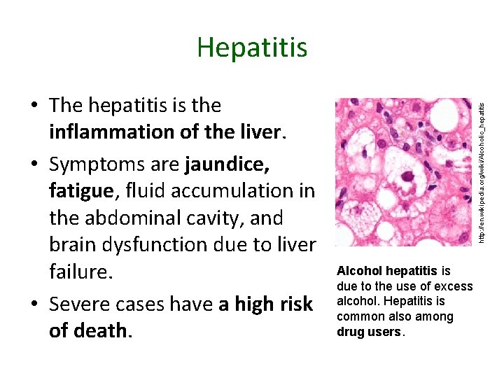  • The hepatitis is the inflammation of the liver. • Symptoms are jaundice,