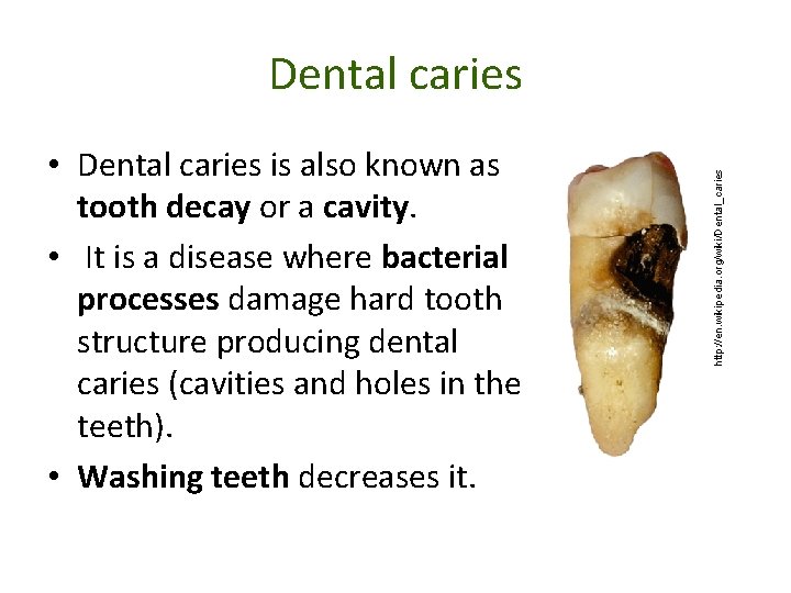  • Dental caries is also known as tooth decay or a cavity. •