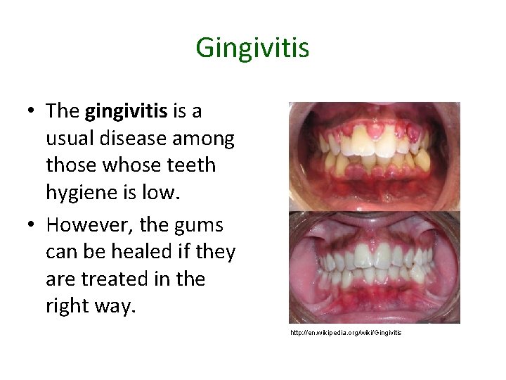 Gingivitis • The gingivitis is a usual disease among those whose teeth hygiene is