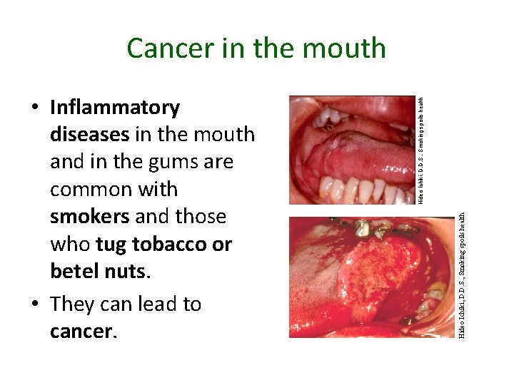 Hideo Ichiki, D. D. S. , Smoking spoils health • Inflammatory diseases in the