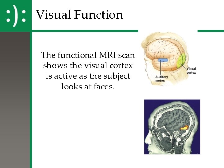 Visual Function The functional MRI scan shows the visual cortex is active as the