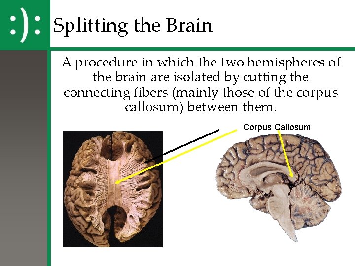 Splitting the Brain A procedure in which the two hemispheres of the brain are