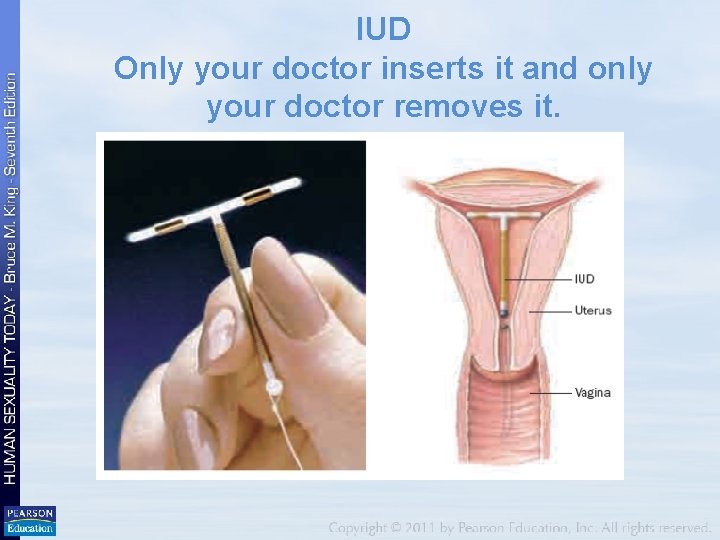 IUD Only your doctor inserts it and only your doctor removes it. 