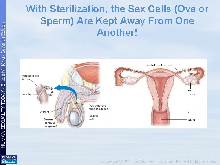 With Sterilization, the Sex Cells (Ova or Sperm) Are Kept Away From One Another!