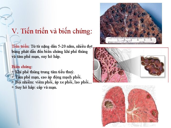 V. Tiến triển và biến chứng: Tiến triển: Từ từ nặng dần 5 -20