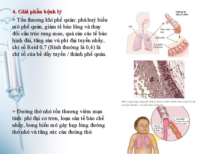 4. Giải phẫu bệnh lý + Tổn thương khí phế quản: phá huỷ biểu