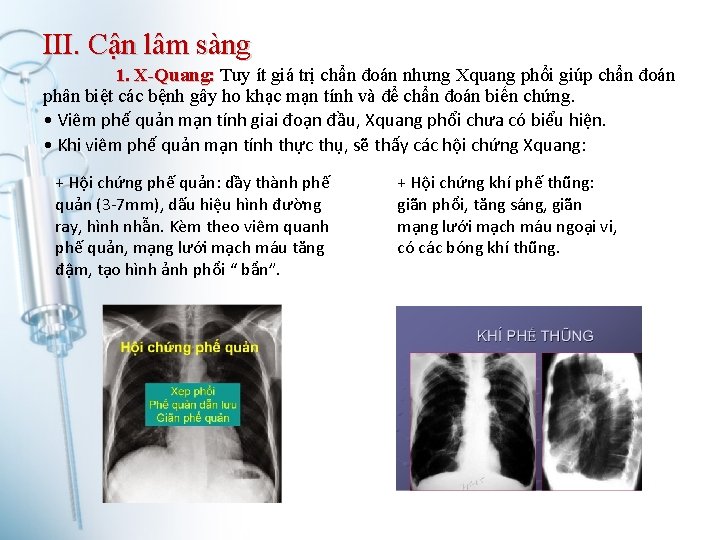 III. Cận lâm sàng 1. X-Quang: Tuy ít giá trị chẩn đoán nhưng Xquang