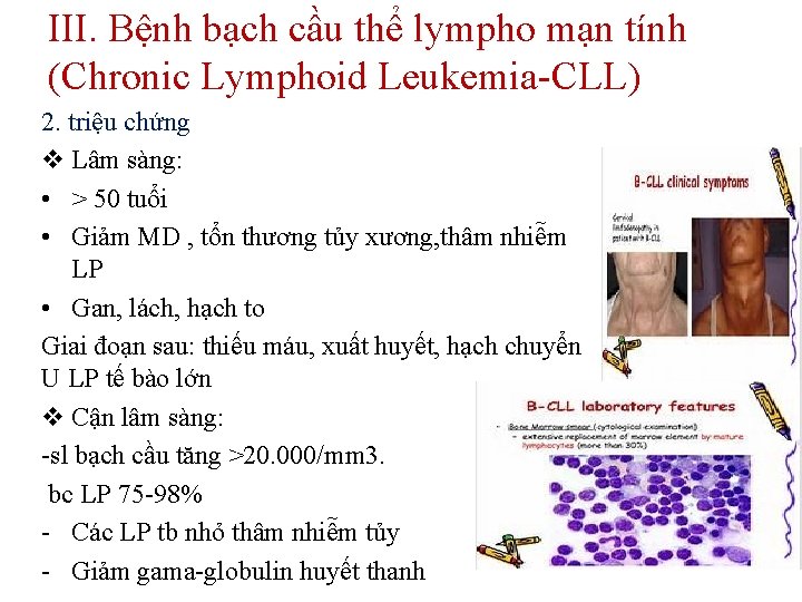 III. Bệnh bạch cầu thể lympho mạn tính (Chronic Lymphoid Leukemia-CLL) 2. triệu chứng