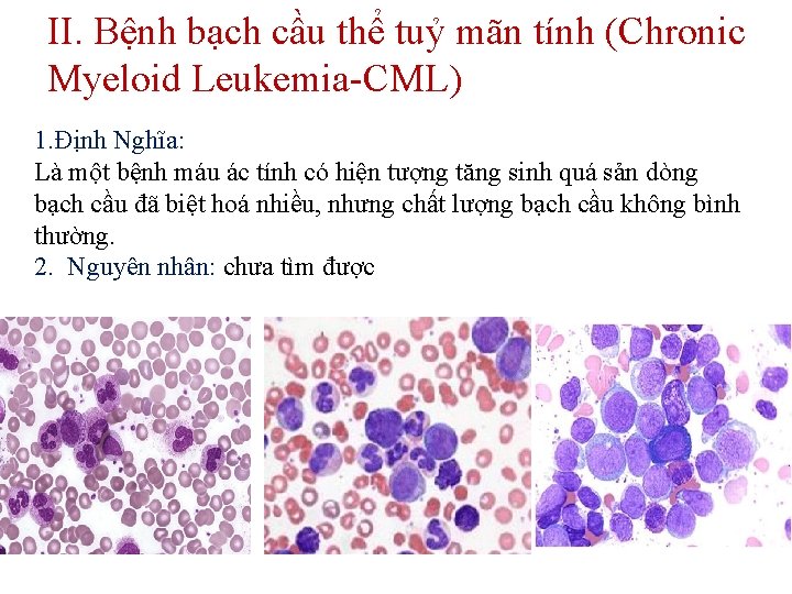 II. Bệnh bạch cầu thể tuỷ mãn tính (Chronic Myeloid Leukemia-CML) 1. Định Nghĩa: