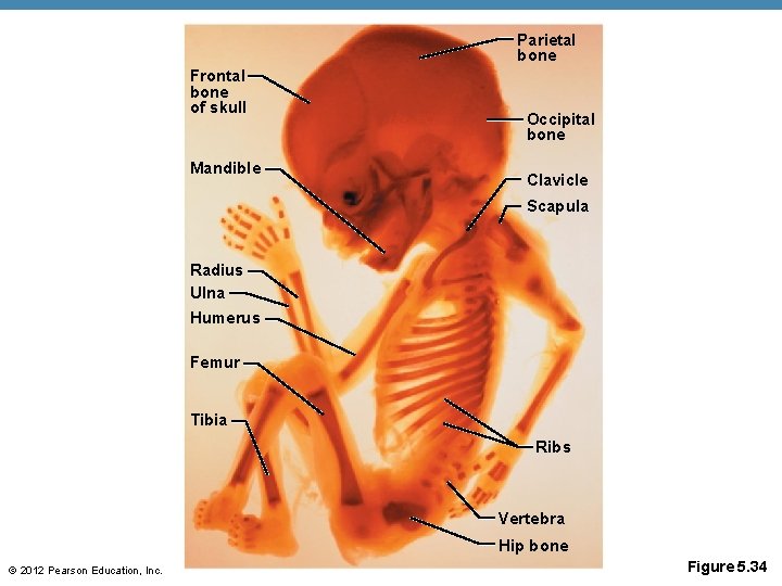 Parietal bone Frontal bone of skull Mandible Occipital bone Clavicle Scapula Radius Ulna Humerus