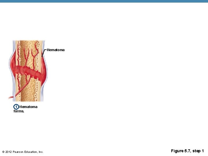 Hematoma 1 Hematoma forms. © 2012 Pearson Education, Inc. Figure 5. 7, step 1