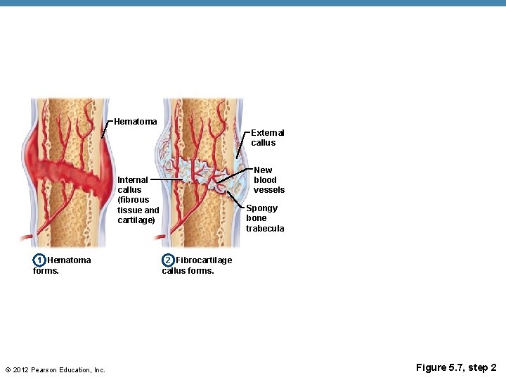 Hematoma External callus New blood vessels Internal callus (fibrous tissue and cartilage) 1 Hematoma