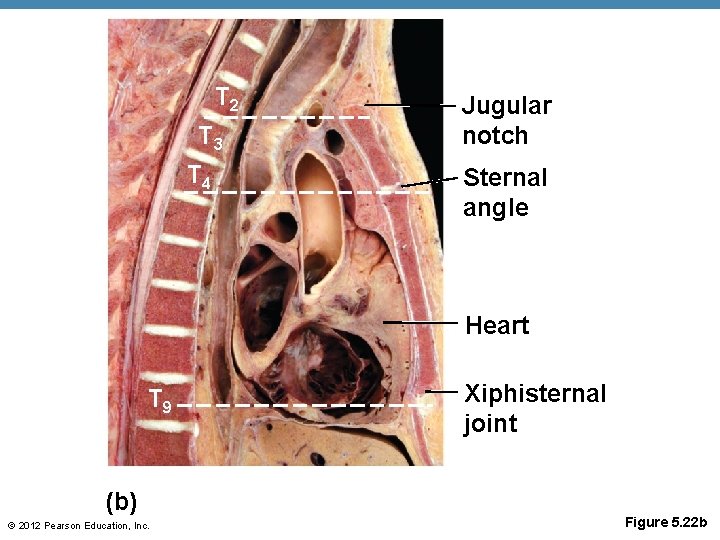 T 2 T 3 T 4 Jugular notch Sternal angle Heart T 9 (b)