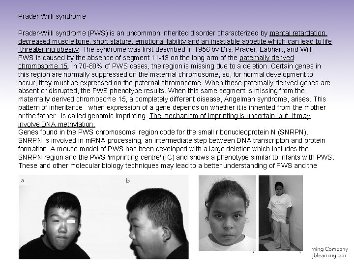 Prader-Willi syndrome (PWS) is an uncommon inherited disorder characterized by mental retardation, decreased muscle