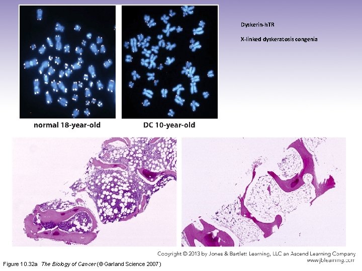 Dyskerin-h. TR X-linked dyskeratosis congenia Figure 10. 32 a The Biology of Cancer (©