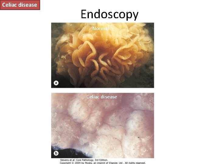 Celiac disease Endoscopy Normal Celiac disease 