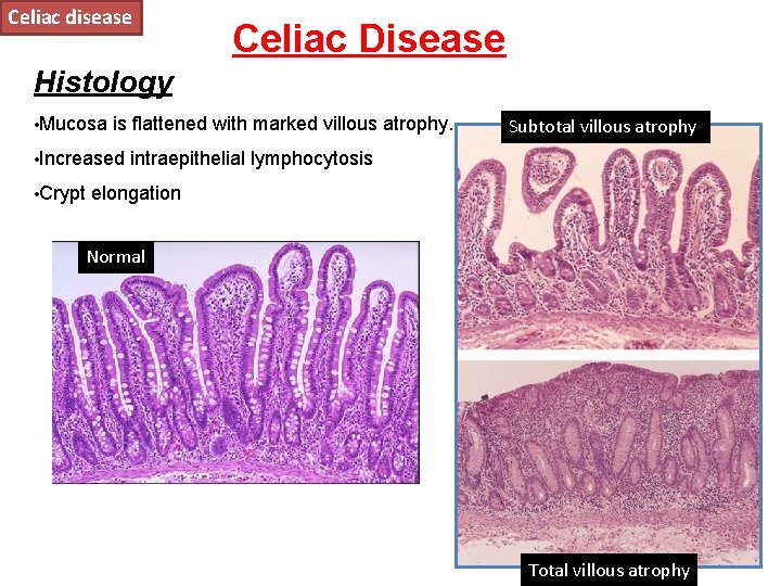 Celiac disease Celiac Disease Histology • Mucosa is flattened with marked villous atrophy. •