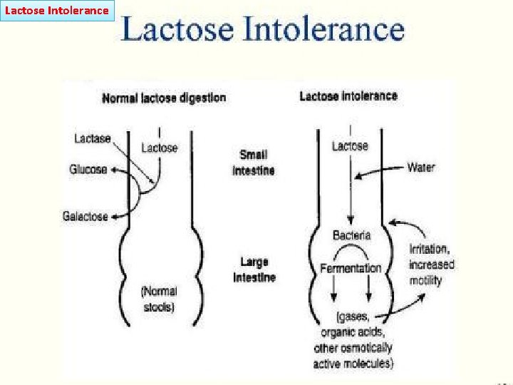 Lactose Intolerance 