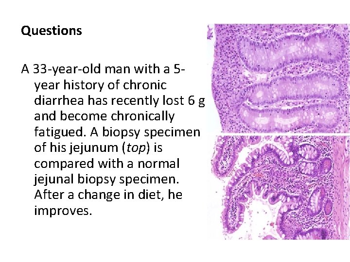 Questions A 33 -year-old man with a 5 year history of chronic diarrhea has