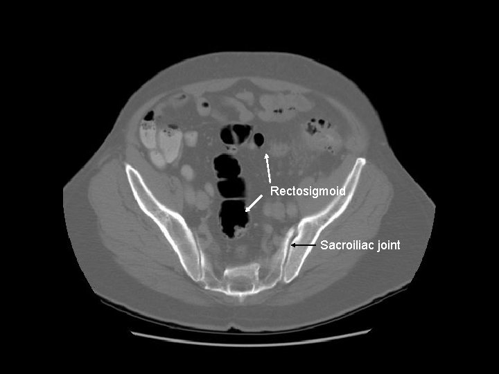 Rectosigmoid Sacroiliac joint 