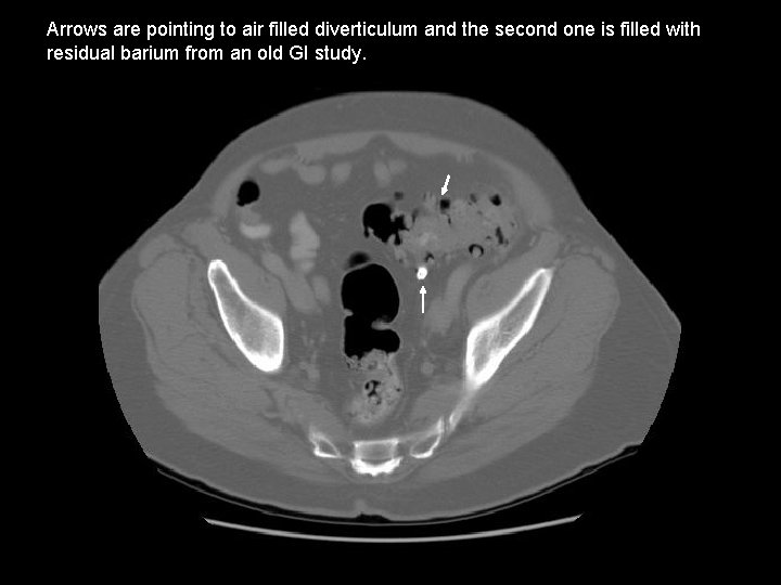 Arrows are pointing to air filled diverticulum and the second one is filled with