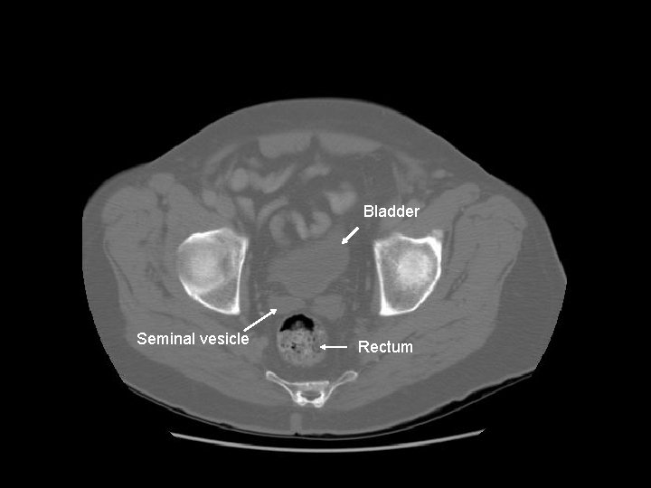 Bladder Seminal vesicle Rectum 