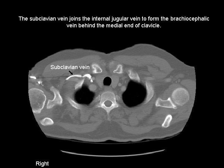The subclavian vein joins the internal jugular vein to form the brachiocephalic vein behind