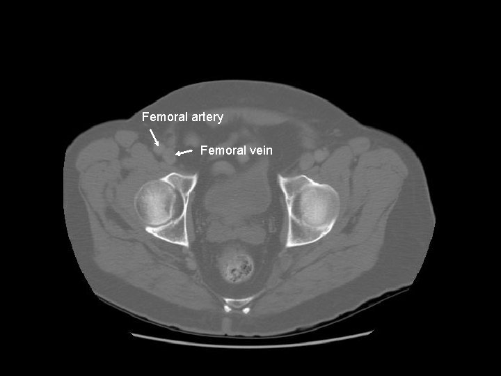 Femoral artery Femoral vein 