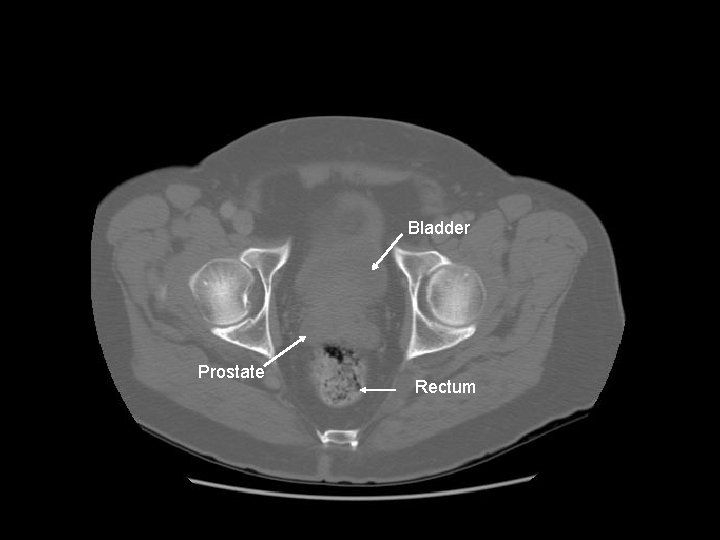 Bladder Prostate Rectum 