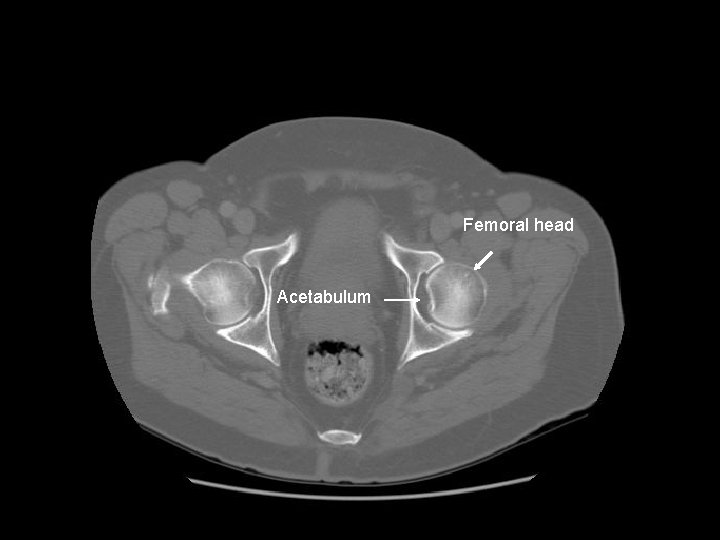 Femoral head Acetabulum 