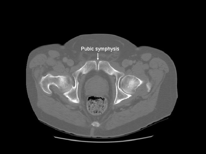 Pubic symphysis 