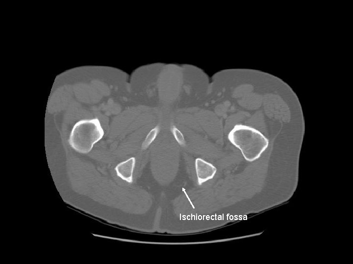 Ischiorectal fossa 