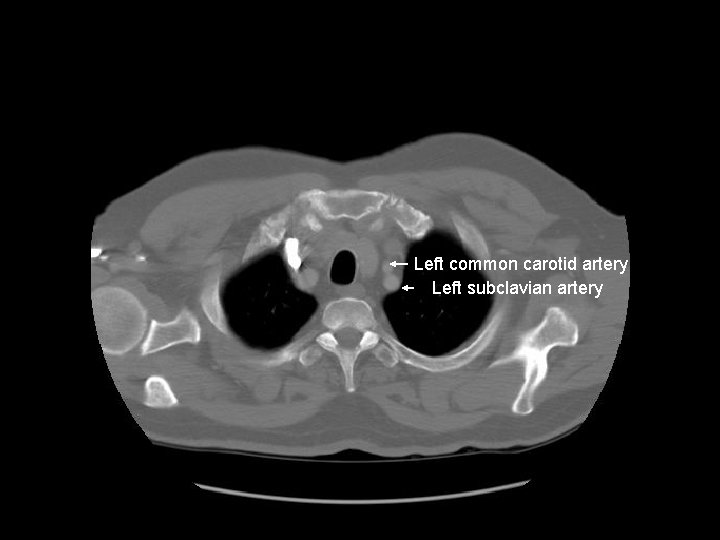 Left common carotid artery Left subclavian artery 