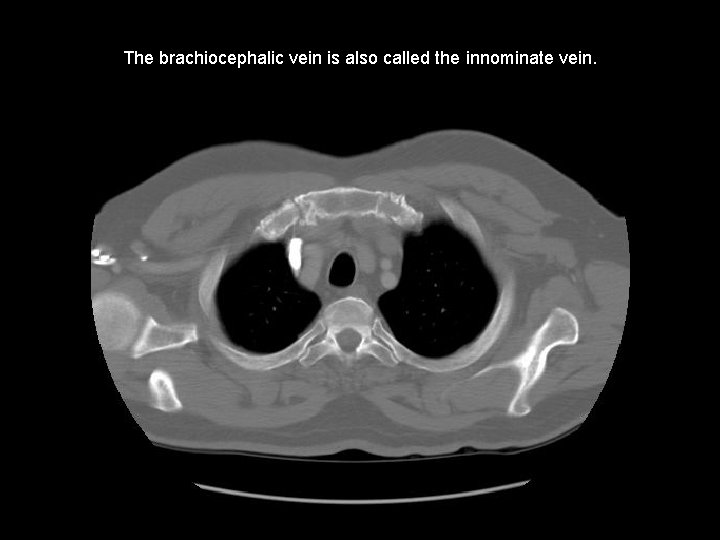 The brachiocephalic vein is also called the innominate vein. 