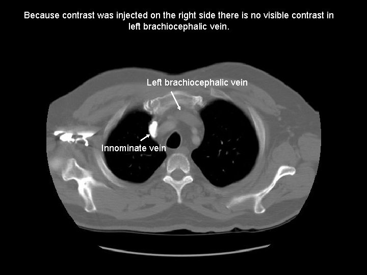 Because contrast was injected on the right side there is no visible contrast in