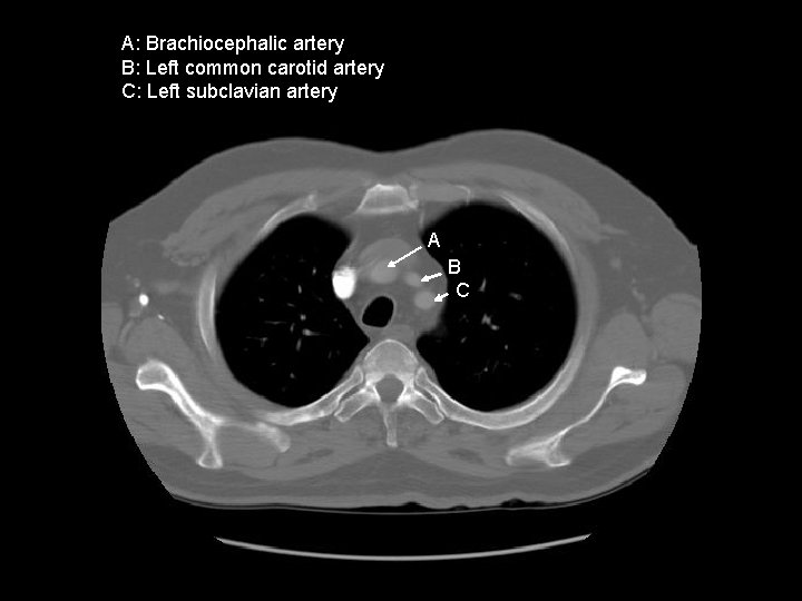 A: Brachiocephalic artery B: Left common carotid artery C: Left subclavian artery A B