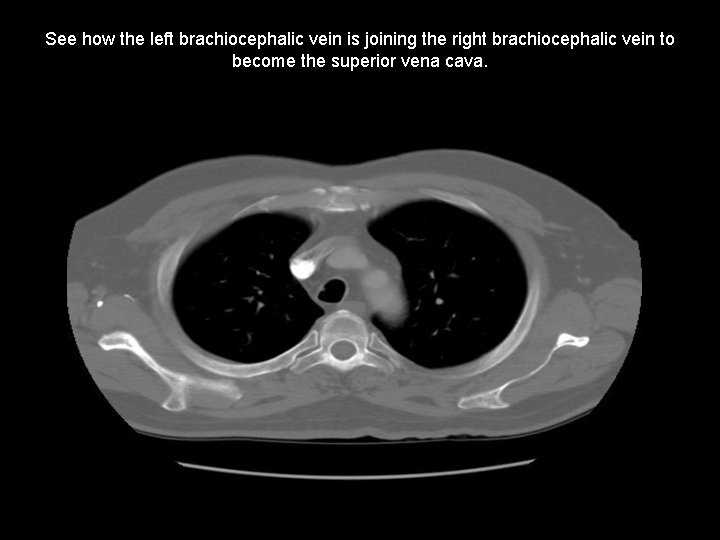 See how the left brachiocephalic vein is joining the right brachiocephalic vein to become