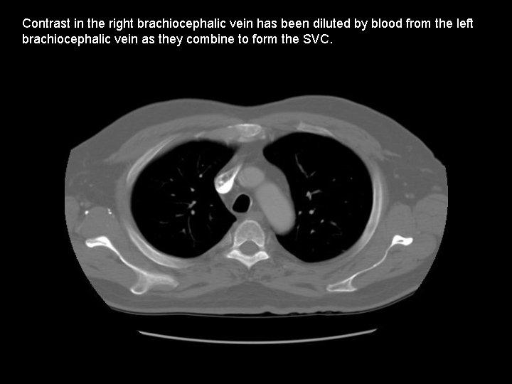 Contrast in the right brachiocephalic vein has been diluted by blood from the left