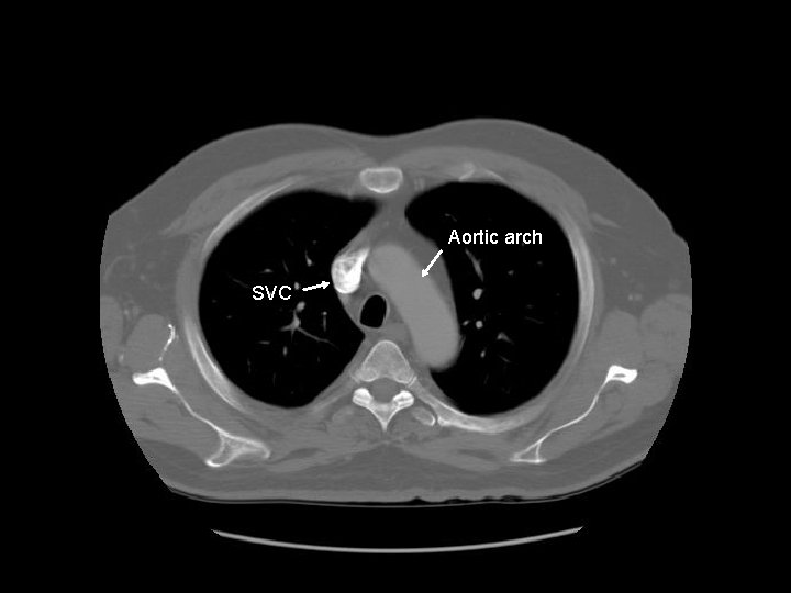 Arch Aortic ofarch aorta SVC 