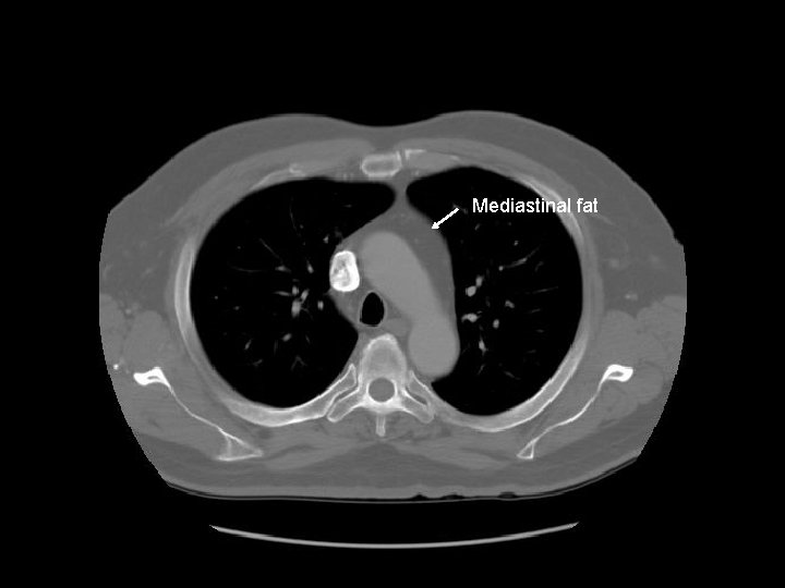 Mediastinal fat 