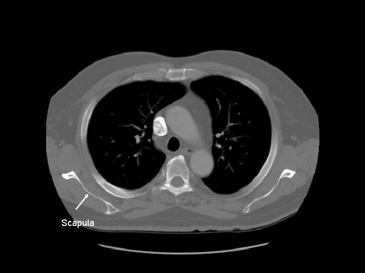 Scapula 