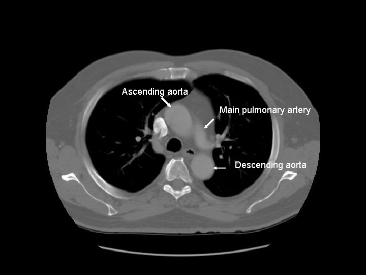 Ascending aorta Main pulmonary artery Descending aorta 