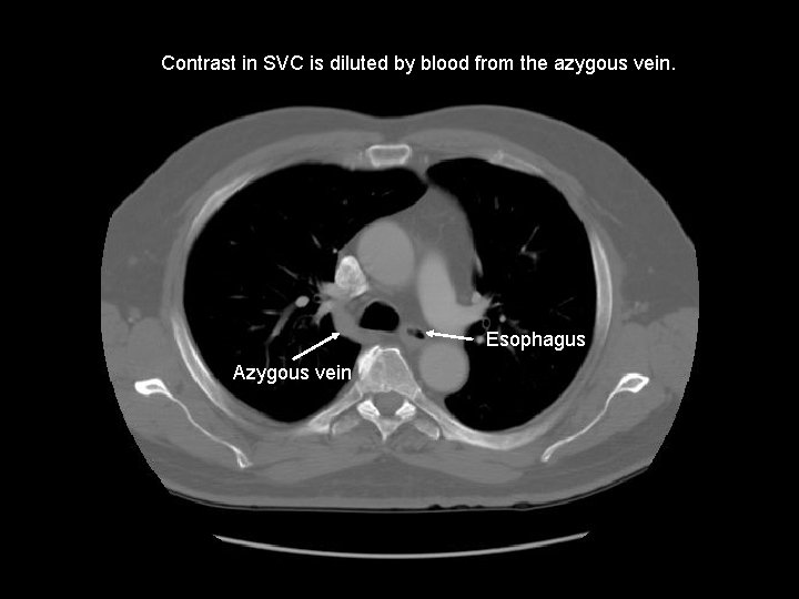 Contrast in SVC is diluted by blood from the azygous vein. Esophagus Azygous vein