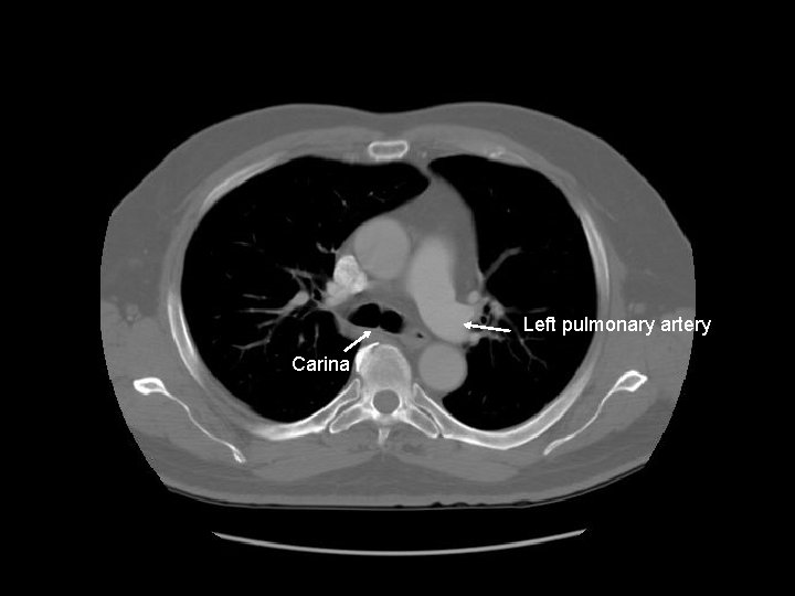 Left pulmonary artery Carina 