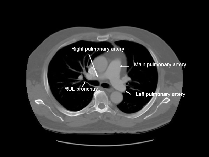Right pulmonary artery Main pulmonary artery RUL bronchus Left pulmonary artery 